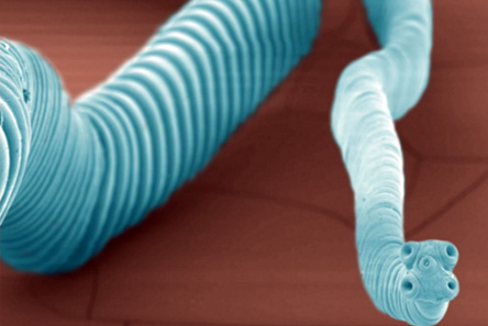 Un Paciente Muere a Causa del Cáncer de su Parásito Intestinal